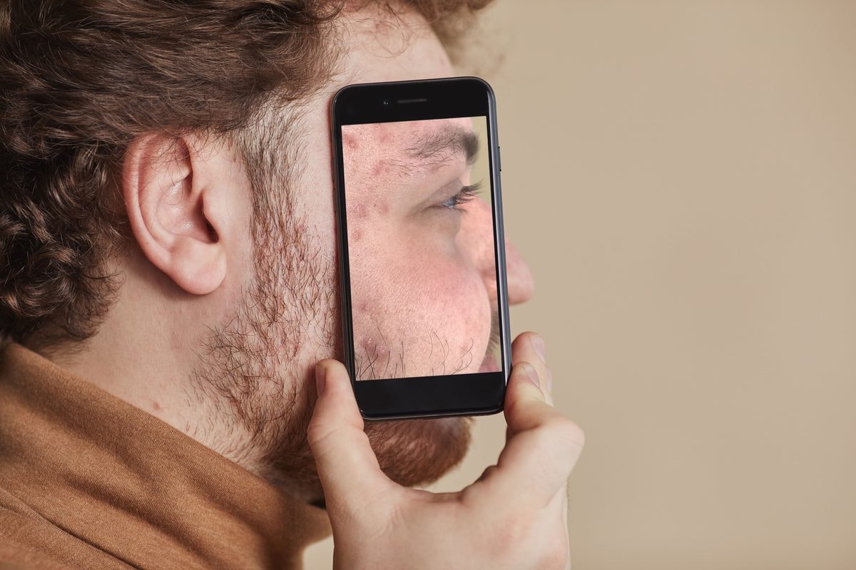 Acne and the Online Doctor – When a Remote Consultation Is Enough