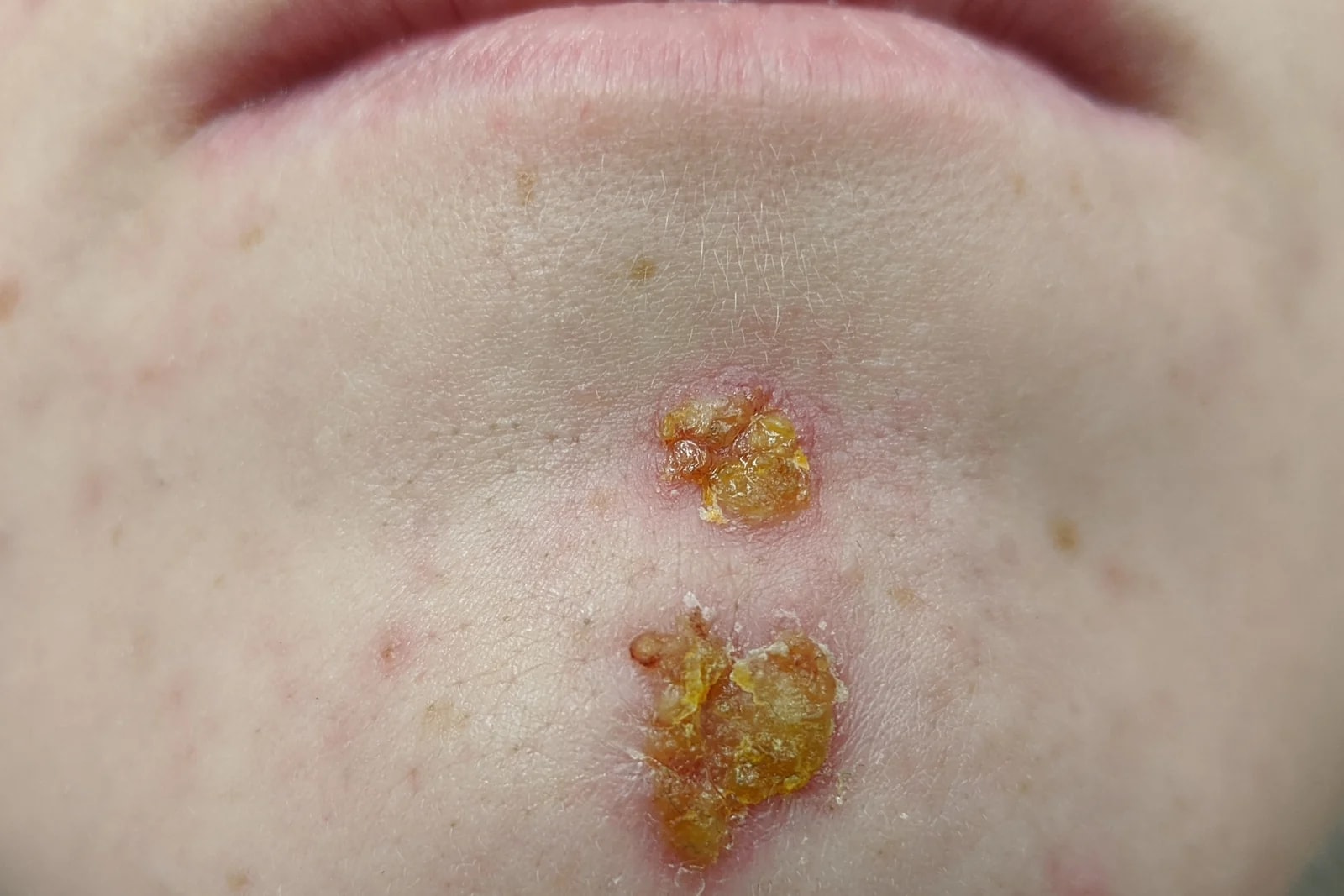 Типичная медово-жёлтая корочка импетиго на подбородке. Фото: James Heilman, MD, CC BY-SA 4.0