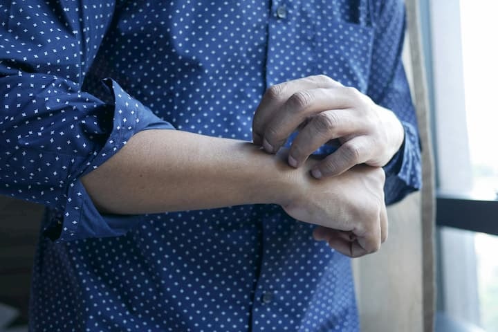 Svampinfektion: symtom, behandling och när du ska söka vård