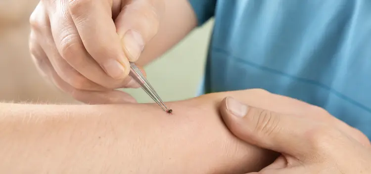 médico remove carraça